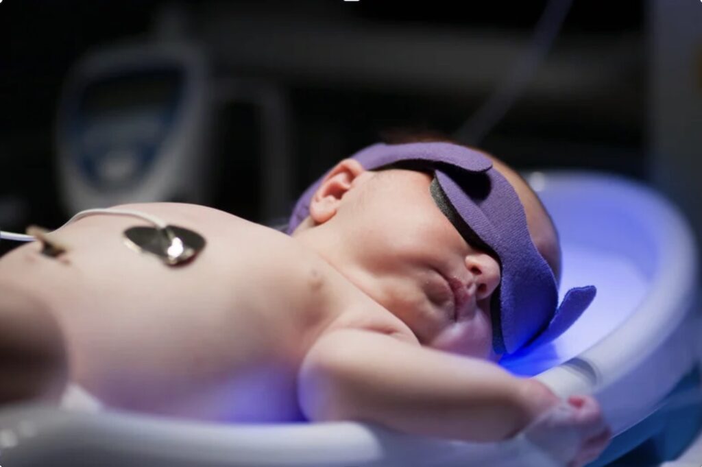 Neonatal Jaundice (Hyperbilirubinemia) Treatment