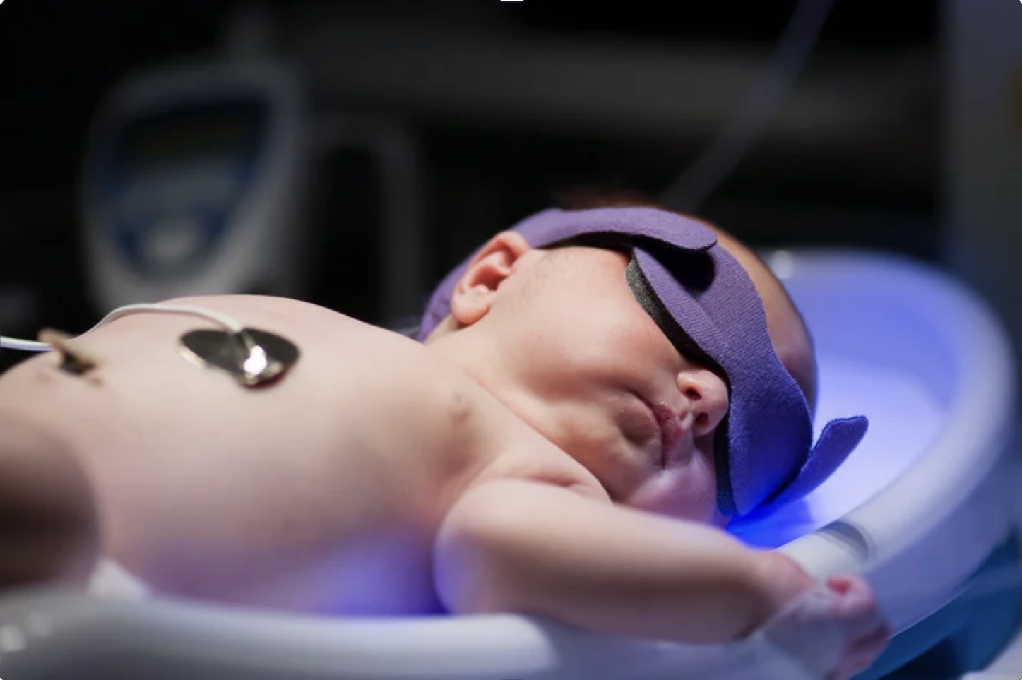 Neonatal Jaundice (Hyperbilirubinemia) Treatment