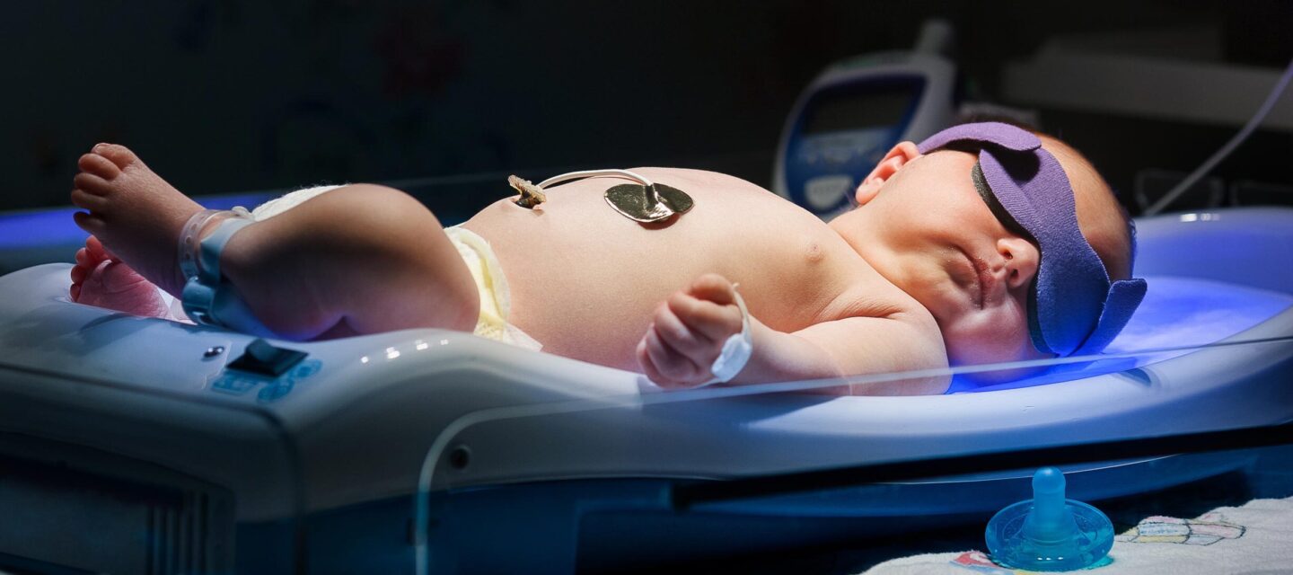 Jaundice in Newborns: Signs Parents Should Watch For
