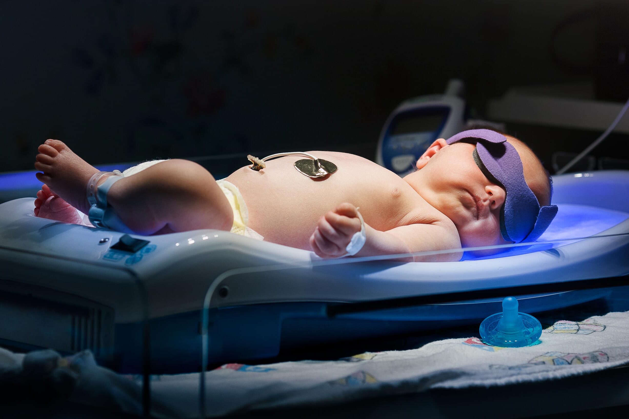 Jaundice in Newborns: Signs Parents Should Watch For