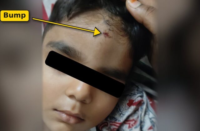 Toddler with a small forehead bump after a fall, arrow pointing to the injury