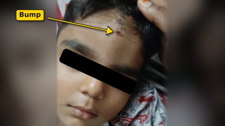 Head Bumps and Falls in Kids: When to Worry and What to Do